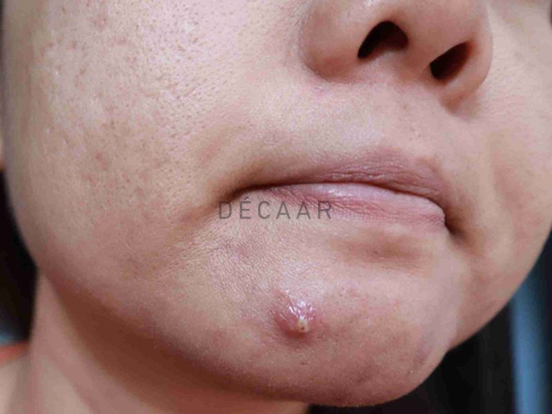 Mụn trứng cá bọc 